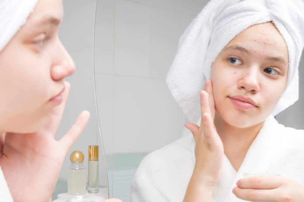 Gây nổi mụn là một tác hại tiềm ẩn của trà sữa khi tiêu thụ quá mức.